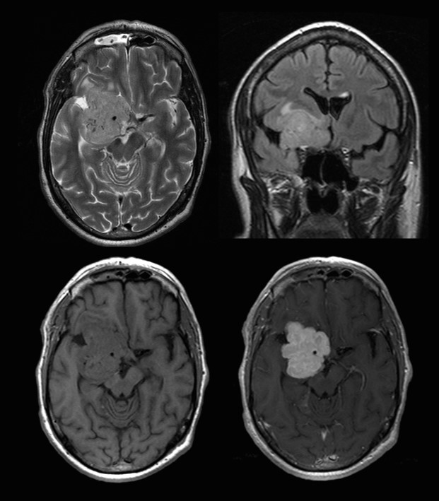 Schweizer Hirntumorstiftung Z Rich Stiftung F R Hirntumor Patienten Krebsbek Mpfung